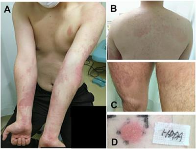 Allergic contact dermatitis to 1,6-hexanediol diacrylate in a factory worker